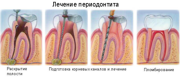 периодонтит