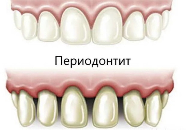 Периодонтит фото