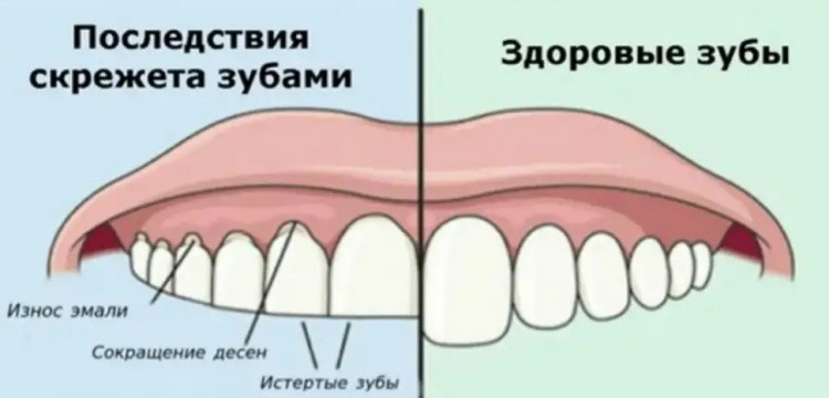 Бруксизм фото